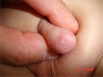 Lichen Sclerosus okozta másodlagos fitymaszűkület gyermeknél