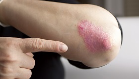 pikkelysömör gyógyszer likopid miért jelentek meg piros foltok a lábak között