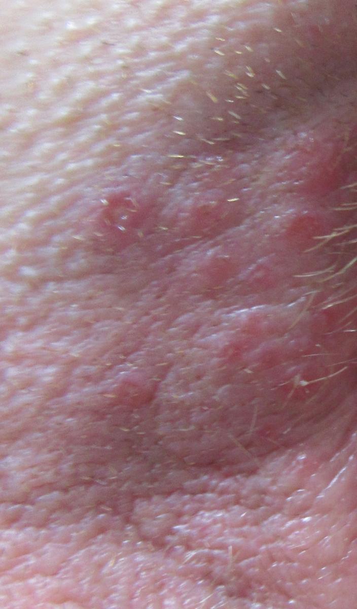 A HPV (humán papillomavírus) fertőzés tünetei, kezelése