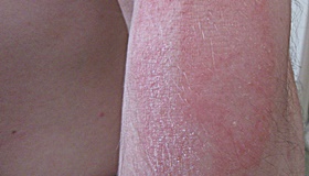 Bőrgomba fertőzés