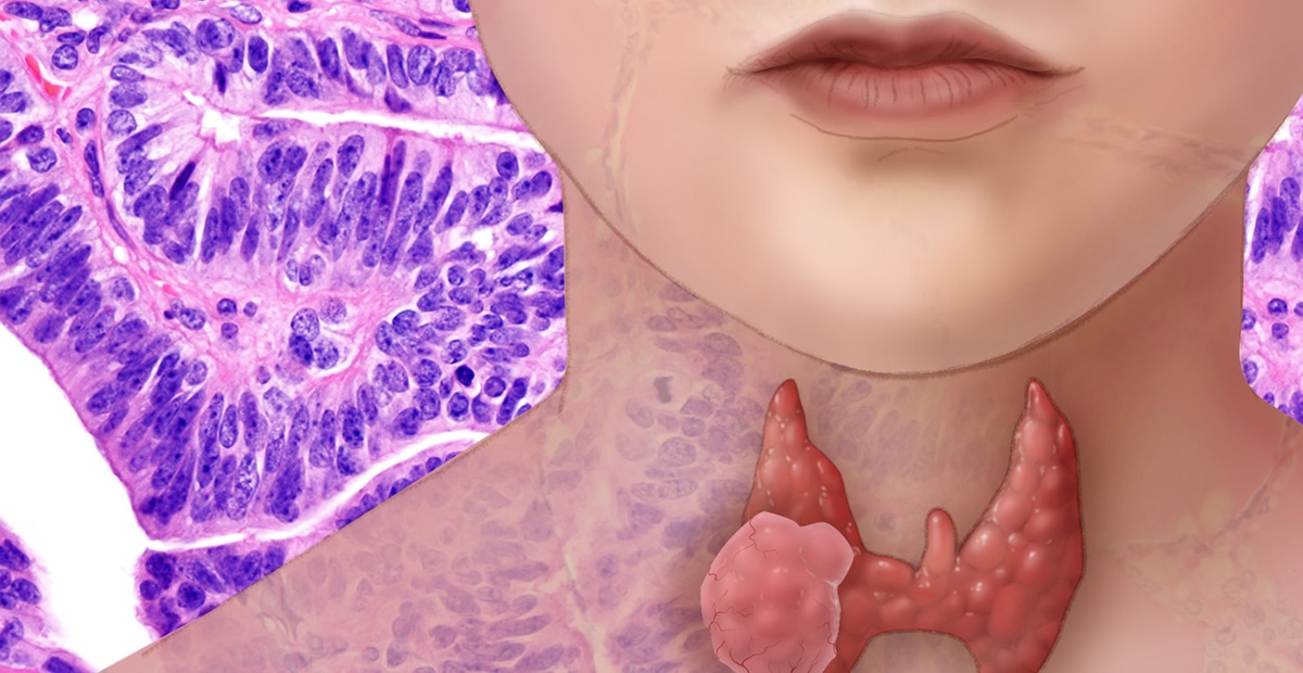 Pajzsmirigyrák tünetei és kezelése Göb rák tünetei