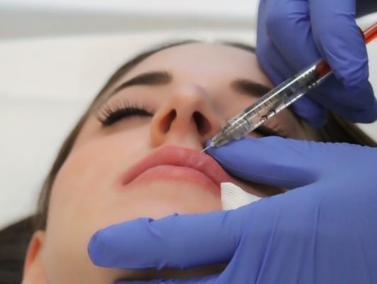 szájfeltöltés, ajakfeltöltés hyaluronsavval