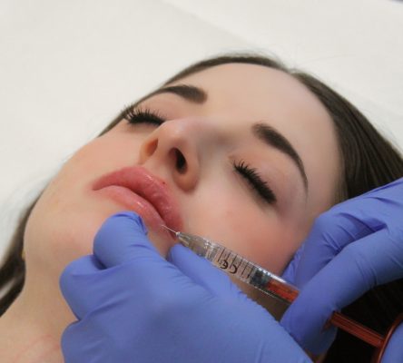 szájfeltöltés, ajakfeltöltés hyaluronsavval