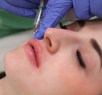 szájfeltöltés, ajakfeltöltés hyaluronsavval