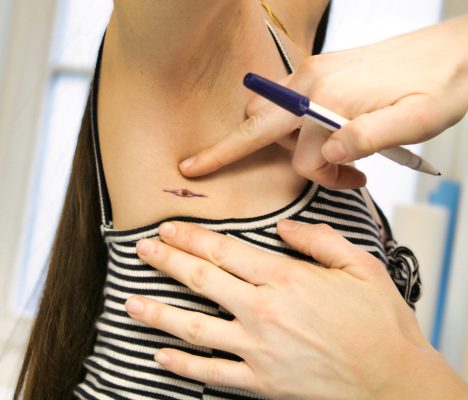 anyajegy eltávolítás, melanoma