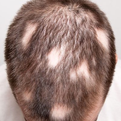 foltos hajhullás alopecia areata
