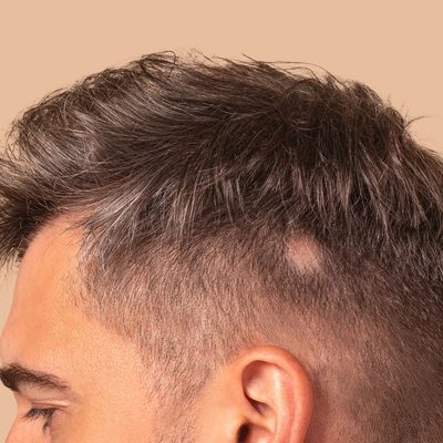 foltos hajhullás alopecia areata