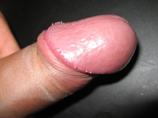 PPP lézeres kezelés