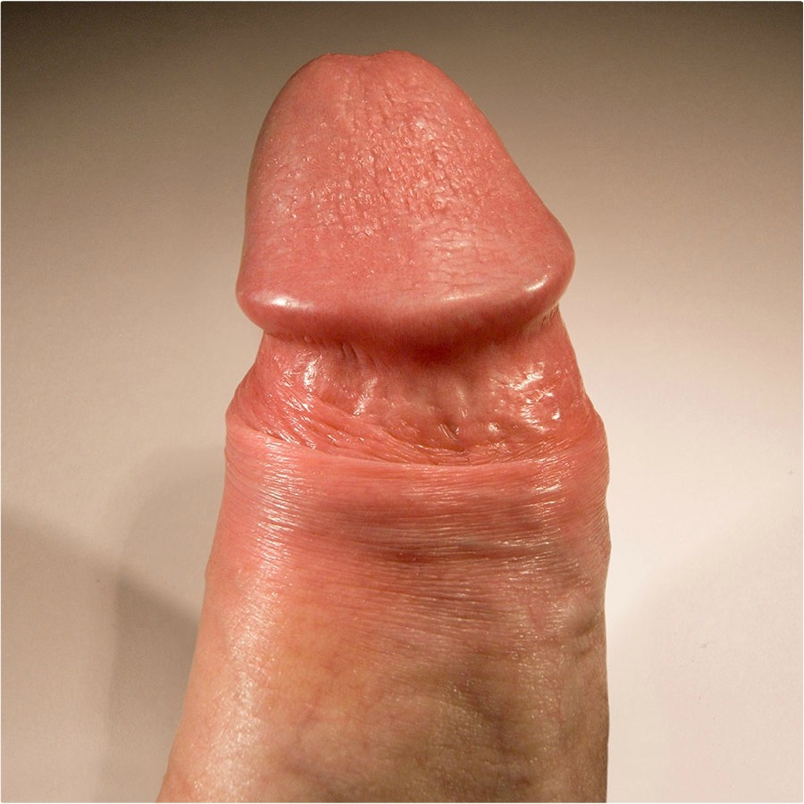 PPP lézeres kezelés után