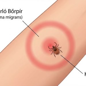 kullancsok által terjesztett betegségek, Lyme-kór tünetei