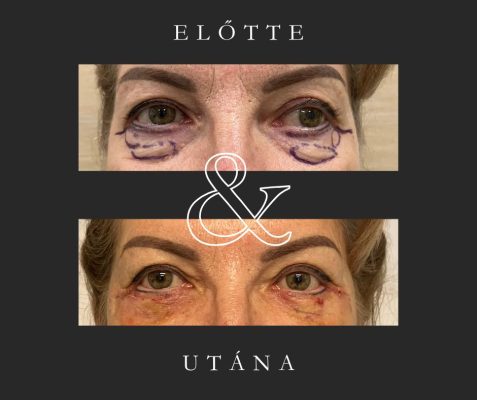 alsó szemhéjplasztika