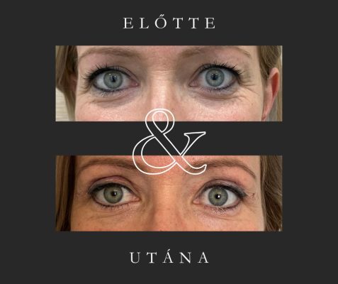 felső szemhéjplasztika (Dr. Képíró László)