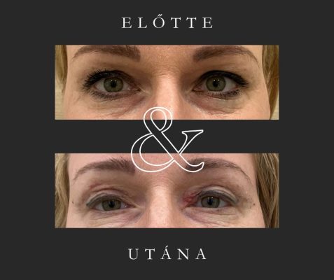 felső szemhéjplasztika (Dr. Képíró László)