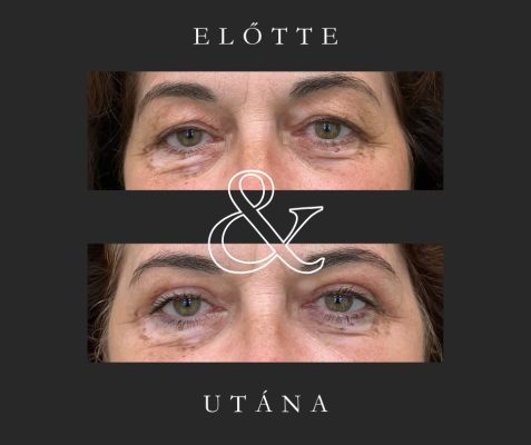 felső szemhéjplasztika (Dr. Képíró László)