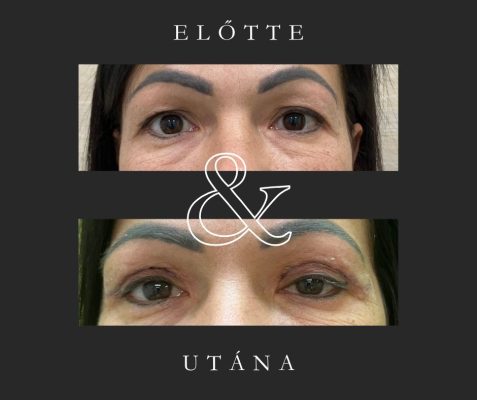 felső szemhéjplasztika (Dr. Képíró László)