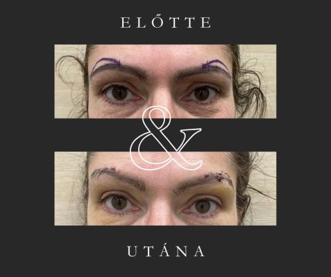 szemöldök fixálás