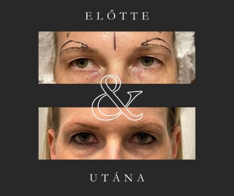 szemöldök fixálás