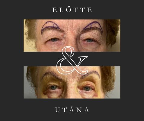 szemöldök fixálás